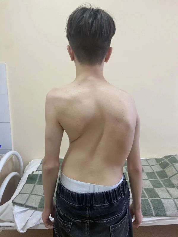 Подростку со сколиозом 4 степени исправили деформацию: самарские травматологи провели 6-часовую операцию в условиях ракетной опасности
