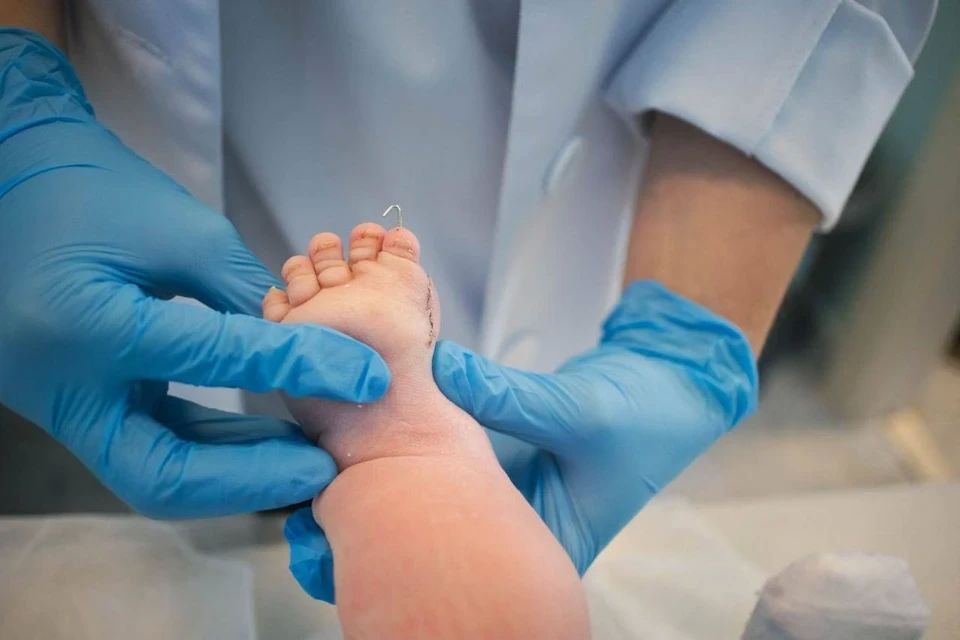 Без кости в ноге и с семью пальцами: самарские врачи спасают полугодовалого малыша от ампутации Без кости в ноге и с семью пальцами: самарские врачи спасают полугодовалого малыша от ампутации